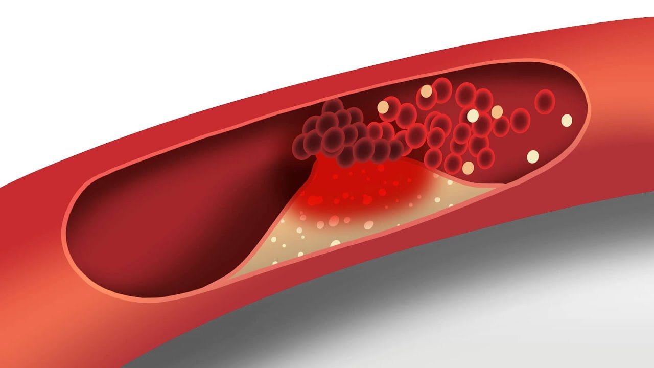 Popping too many statins to decrease cholesterol? Watch out for type-2 diabetes risk 1