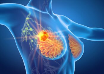 6 Ways to Prevent Breast Cancer in the Future