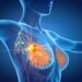 Treating Metastatic Breast Cancer: How to Live Longer with Less Pain